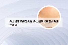 身上经常长癣怎么办 身上经常长癣怎么办用什么药