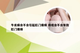 牛皮癣会不会引起肛门瘙痒 痔疮会不会导致肛门瘙痒