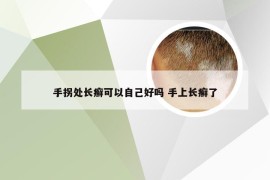 手拐处长癣可以自己好吗 手上长癣了