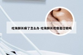 吃海鲜长癣了怎么办 吃海鲜长疙瘩是过敏吗