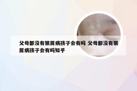 父母都没有银屑病孩子会有吗 父母都没有银屑病孩子会有吗知乎