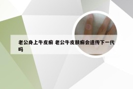 老公身上牛皮癣 老公牛皮肤癣会遗传下一代吗