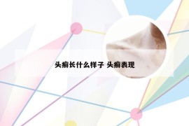 头癣长什么样子 头癣表现