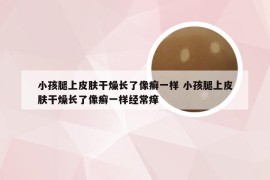 小孩腿上皮肤干燥长了像癣一样 小孩腿上皮肤干燥长了像癣一样经常痒