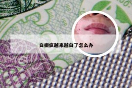 白癫疯越来越白了怎么办