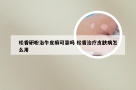 松香研粉治牛皮癣可靠吗 松香治疗皮肤病怎么用