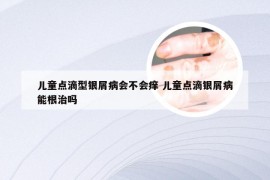 儿童点滴型银屑病会不会痒 儿童点滴银屑病能根治吗