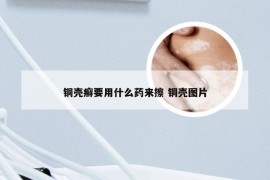 铜壳癣要用什么药来擦 铜壳图片