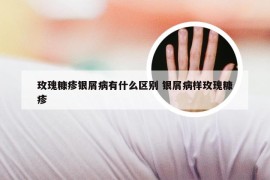 玫瑰糠疹银屑病有什么区别 银屑病样玫瑰糠疹