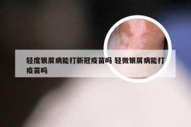 轻度银屑病能打新冠疫苗吗 轻微银屑病能打疫苗吗