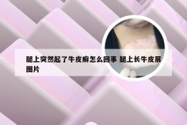 腿上突然起了牛皮癣怎么回事 腿上长牛皮屑图片