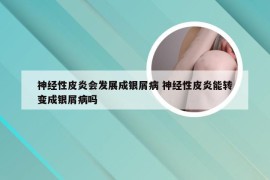 神经性皮炎会发展成银屑病 神经性皮炎能转变成银屑病吗