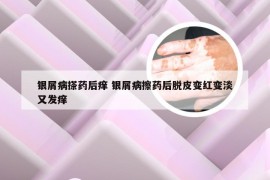 银屑病搽药后痒 银屑病擦药后脱皮变红变淡又发痒