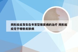 同形反应发生在寻常型银屑病的治疗 同形反应见于哪些皮肤病