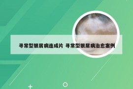 寻常型银屑病连成片 寻常型银屑病治愈案例