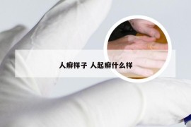 人癣样子 人起癣什么样