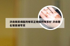 济南银屑病医院哪家正规医院哪家好 济南著名银屑病专家