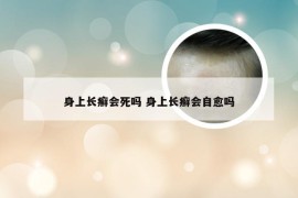 身上长癣会死吗 身上长癣会自愈吗