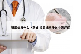 银屑病用什么中药好 银屑病用什么中药好呢