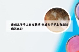 亲戚儿子手上有皮肤病 亲戚儿子手上有皮肤病怎么说