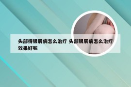 头部得银屑病怎么治疗 头部银屑病怎么治疗效果好呢