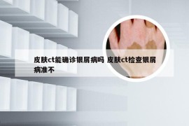 皮肤ct能确诊银屑病吗 皮肤ct检查银屑病准不