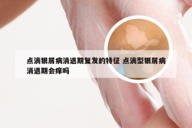 点滴银屑病消退期复发的特征 点滴型银屑病消退期会痒吗