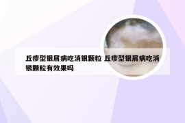 丘疹型银屑病吃消银颗粒 丘疹型银屑病吃消银颗粒有效果吗