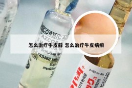 怎么治疗牛皮藓 怎么治疗牛皮病癣