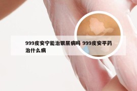 999皮安宁能治银屑病吗 999皮安平药治什么病