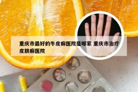 重庆市最好的牛皮癣医院是哪家 重庆市治疗皮肤癣医院