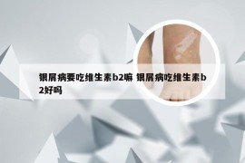 银屑病要吃维生素b2嘛 银屑病吃维生素b2好吗