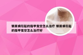 银屑病引起的指甲变空怎么治疗 银屑病引起的指甲变空怎么治疗好