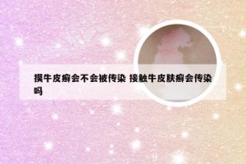 摸牛皮癣会不会被传染 接触牛皮肤癣会传染吗