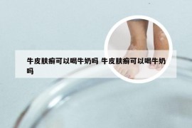 牛皮肤癣可以喝牛奶吗 牛皮肤癣可以喝牛奶吗