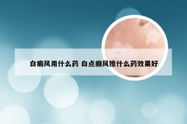 白癜风用什么药 白点癫风擦什么药效果好