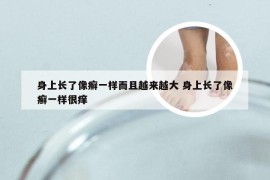 身上长了像癣一样而且越来越大 身上长了像癣一样很痒