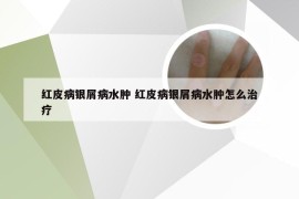 红皮病银屑病水肿 红皮病银屑病水肿怎么治疗