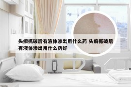 头癣抓破后有液体渗出用什么药 头癣抓破后有液体渗出用什么药好