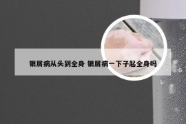 银屑病从头到全身 银屑病一下子起全身吗