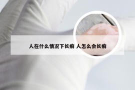 人在什么情况下长癣 人怎么会长癣