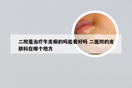 二院是治疗牛皮癣的吗能看好吗 二医院的皮肤科在哪个地方