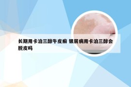 长期用卡泊三醇牛皮癣 银屑病用卡泊三醇会脱皮吗