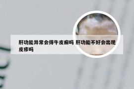 肝功能异常会得牛皮癣吗 肝功能不好会出现皮疹吗