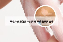 干性牛皮癣怎用什么药呀 干癣是银屑病吗