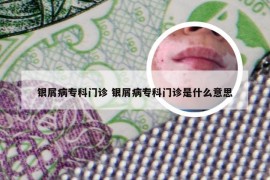 银屑病专科门诊 银屑病专科门诊是什么意思