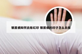 银屑病如何去除红印 银屑病的印子怎么去除