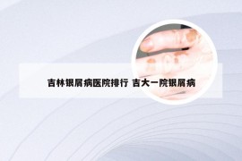 吉林银屑病医院排行 吉大一院银屑病