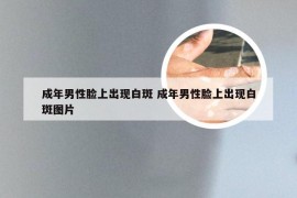 成年男性脸上出现白斑 成年男性脸上出现白斑图片