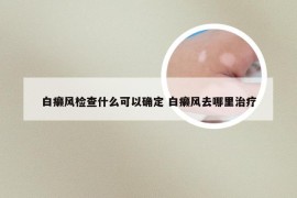 白癞风检查什么可以确定 白癞风去哪里治疗